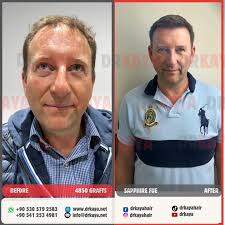 Watch Matthew Nicholas Callan who had a previous surgery in UK, sharing his  experience with us the day after his hair transplant surgery. We do  hundreds of corrections surgeries to people