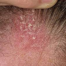 Image result for white scabs on the head in children