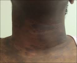 Image result for Diffuse Hyperpigmentation