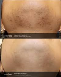 Laser hair removal is suitable for both men and women. Laser Hair Removal Ei Con Health Wellness Center