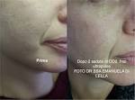 Laser cofrazionato, effetti collaterali, costi e opinioni MedicinaLive