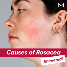 Image result for demodex rosacea