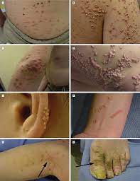 They include hyperlipemic xanthoma, normolipemic xanthoma, and a related condition, necrobiotic xanthogranuloma (nxg). Eruptive Xanthomas After The Initiation Of Olanzapine Therapy The Download Scientific Diagram