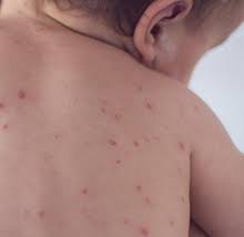 Terdapat banyak alasan potensial mengapa bayi mengalami bintik merah atau ruam. Timbulnya Bintik Merah Pada Kulit Bayi Nutriclub