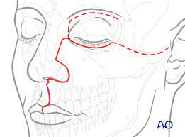 Maybe you would like to learn more about one of these? Weber Ferguson Approach
