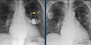Huge collection, amazing choice, 100+ million high quality, affordable rf and rm images. The Radiology Assistant Cardiovascular Devices