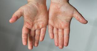Image result for Hand foot and mouth disease HFMD roof of mouth