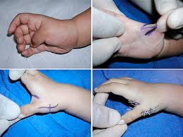 Pulgar — original name in latin pulgar name in other language pulgar state code es continent/city europe/madrid longitude 39.69383 latitude 4.15233 altitude 723 population 1393 date 2012 03 04 … Aduccion Y Flexion El Pulgar Con Cierre De Primera Comisura Apertura Download Scientific Diagram