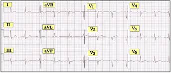 Pediatric Ekg 15 Lead Placement Diagram Catalogue Of Schemas