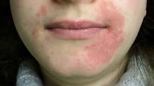 What Is Perioral Dermatitis? Symptoms, Causes, Diagnosis, Treatment, And  Prevention | Everyday Health