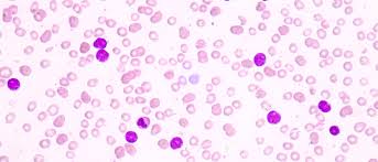 Leukämien (blutkrebs) sind krankheiten der blutzellen, die erwachsene und kinder betreffen können. Wat Is Acute Lymfatische Leukemie Mijn Gezondheidsgids