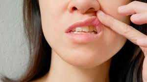 Simpan ditempat yang kering dan sejuk. Tanpa Albothyl Bagaimana Mengobati Sariawan Ini Jawabannya Pos Kupang