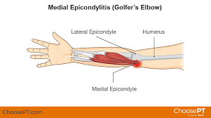Lateral epicondylitis occurs 7 to 10 times more often than medial epicondylitis or golfer's elbow. Physical Therapy Guide To Golfer S Elbow Medial Epicondylitis Choosept Com