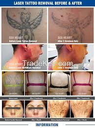 Narrow your search by choosing a location below. Hot Sale Q Switch Nd Yag Laser Tattoo Removal Machine With Ce Iso Certificate By Beijing Sea Heart China