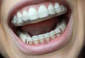 How To Clean Each Type Of Retainer How To Clean Retainers Dental Retainer Retainer Teeth