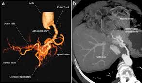 The portal vein or hepatic portal vein (hpv) is a blood vessel that carries blood from the gastrointestinal tract, gallbladder, pancreas and spleen to the liver. All About Portal Vein A Pictorial Display To Anatomy Variants And Physiopathology Insights Into Imaging Full Text