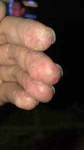 Fungal / kulat pada kulit. Kulit Pada Jari Menggelupas Teruk Sehingga Berair Berbau Sangka Dijangkiti Kulat Air Biasa Setahun Akhmar Derita Ekzema Keluarga
