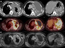 Mesothelioma is a rare type of cancer of the tissue that lines your internal organs. Radiologic Considerations And Standardization Of Malignant Pleural Mesothelioma Imaging Within Clinical Trials Consensus Statement From The Nci Thoracic Malignancy Steering Committee International Association For The Study Of Lung Cancer Mesothelioma