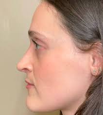 Rhinoplasty Before and After Photos