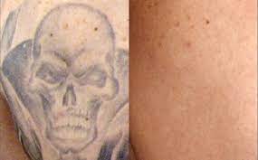 If any product/service purchase doesn't deliver on its promise (or isn't safe) it can't be deemed worth the cost. Tattoo Removal Worth It Wheaton Laser Tattoo Removal