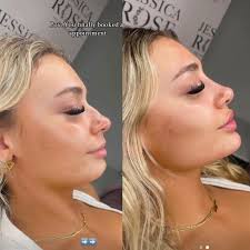 Recommendations for eye lift procedures?