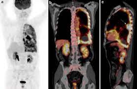 After a course of chemotherapy, the patient developed lower back pain. Pseudomesotheliomatous Lung Cancer Mimicking Mesothelioma On 18f Fdg Pet Ct Images Report Of 2 Cases Springerlink