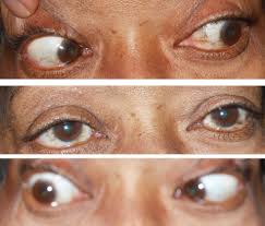 Image result for Pupillary Paralysis