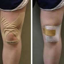 Pdf The Effects Of Two Therapeutic Patellofemoral Taping Techniques On Strength Endurance And Pain Responses