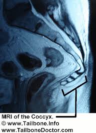 Mri Of The Coccyx Tailbone Showing A Sharp Angle Forward Into The Pelvis Www Tailbonedoctor Com Dr Patrick Foye M D Tailbone My Spine Health Pinte