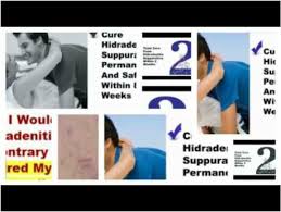 Fast Hidradenitis Suppurativa Cure Review The Secret Of Hidradenitis Suppurativa Treatment Naturally And Immediately