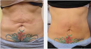 ᐉ RF лифтинг живота в Киеве по цене от 600 грн • РФ лифтинг зоны живота —  радиоволновой лифтинг живота в Bellezza