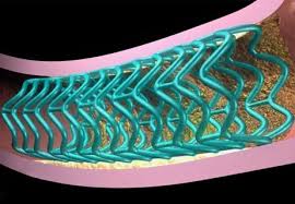 bioresorbable stent - Cleveland Clinic