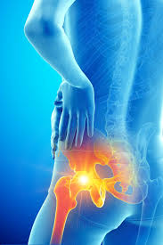 "Waarom heb ik een brandende pijn in mijn heup?" - Fysiotherapeuten