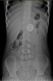 Complete cryptocurrency market coverage with live coin prices, charts and crypto market cap featuring 4963 coins on 240 exchanges. Ingested Coin Radiology Case Radiopaedia Org