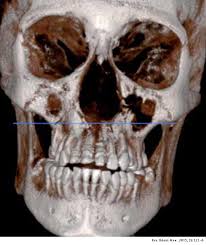 La mucormicosis rinocerebral es una infección oportunista infrecuente, con mayor prevalencia en inmunodeprimidos. Paciente Endodontico Con Mucormicosis Rinocerebral Reporte De Un Caso1 Revista Odontologica Mexicana