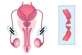 Os espermatozoides são conduzidos através da uretra ao exterior, no momento da ejaculação. Vasectomia O Que E Procedimento Vantagens Brasil Escola
