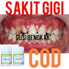 Salah satu penyebab gusi bengkak dan sakit adalah karena kekurangan asupan kebutuhan nutrisi (gizi). Obat Sakit Gigi Obat Herbal Sakit Gigi Gusi Bengkak Gusi Bernanah Naturindo Shopee Indonesia