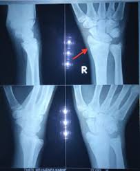 Image result for Hand Growth Plates