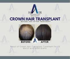 Check spelling or type a new query. Before Hair Transplant Specialist At Alps Medical Centre Facebook