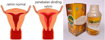 Penebalan dinding rahim atau hyperplasia endometrium adalah suatu kondisi dimana timbul permasalahan terjadinya penebalan atau pertumbuhan yang berlebihan dari dinding rahim atau endometrium, yang umumnya terjadi pengelupasan pada saat menstruasi, yang berakibat dapat. Jelly Gamat Manfaat Penebalan Dinding Rahim Penyebab Gejala Dan Pencegahan