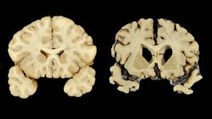 Chronic traumatic encephalopathy, a neurological disorder observed in professional athletes with repeat brain trauma. Nearly 90 Of Former Football Players Studied Had Brain Disease Cte The Globe And Mail
