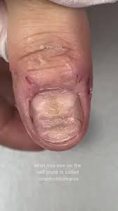 Image result for Onychotillomania feet