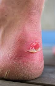 In most cases, blisters are caused by friction, but they can also occur due to things such as infection, burns. Blisters And Diabetic Foot Care