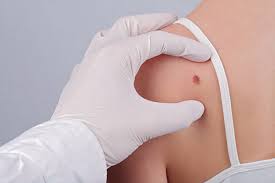 Surgery is the main treatment for most melanomas. Mohs Surgery For Melanoma In Situ Where We Stand Melanoma Research Alliance