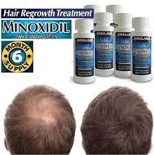 The hair will look thicker over time. Pin On 6 Month Supply Kirkland Minoxidil 5 Extra Strength Hair Men Regrowth Solution