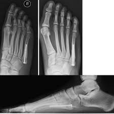 A protective boot, cast, or stiff. Pdf Fifth Metatarsal Fractures In The Athlete Evidence For Management