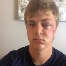 Gruesome injury didn't slow Rider's Moffat