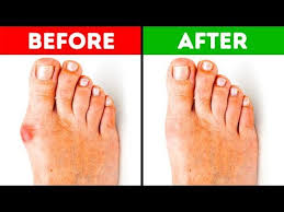 Combine the following sentences using until, till, before or after. 6 Exercises To Fix Bunions Youtube