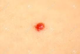 Cherry angiomas are common, harmless spots on the skin. Cherry Angioma Or Campbell De Morgan Spots Stock Photo Picture And Royalty Free Image Image 61983911