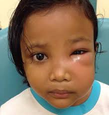 MANAGEMENT OF ACUTE OROFACIAL INFECTION OF ODONTOGENIC ORIGIN IN CHILDREN  (1st Edition)